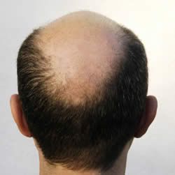 hair photo:hair loss wigs 